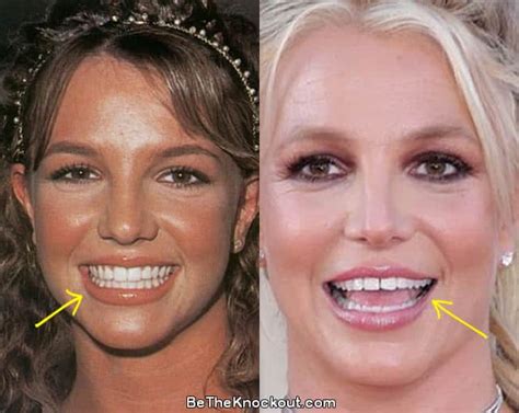 britney spears gap teeth|britney spears teeth changed.